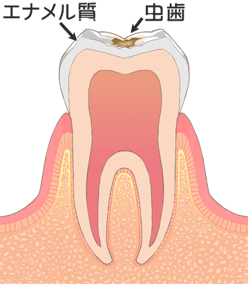 C1：エナメル質がむし歯菌で溶かされてしまった状態