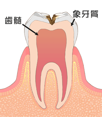 C2：象牙質にむし歯菌が侵入してしまった状態