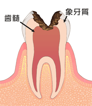 C3：歯髄がむし歯に侵されてしまった状態