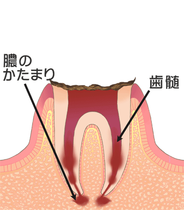 C4：むし歯が大きすぎて抜く以外に方法がない場合