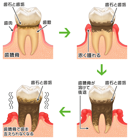 歯周病進行イメージ